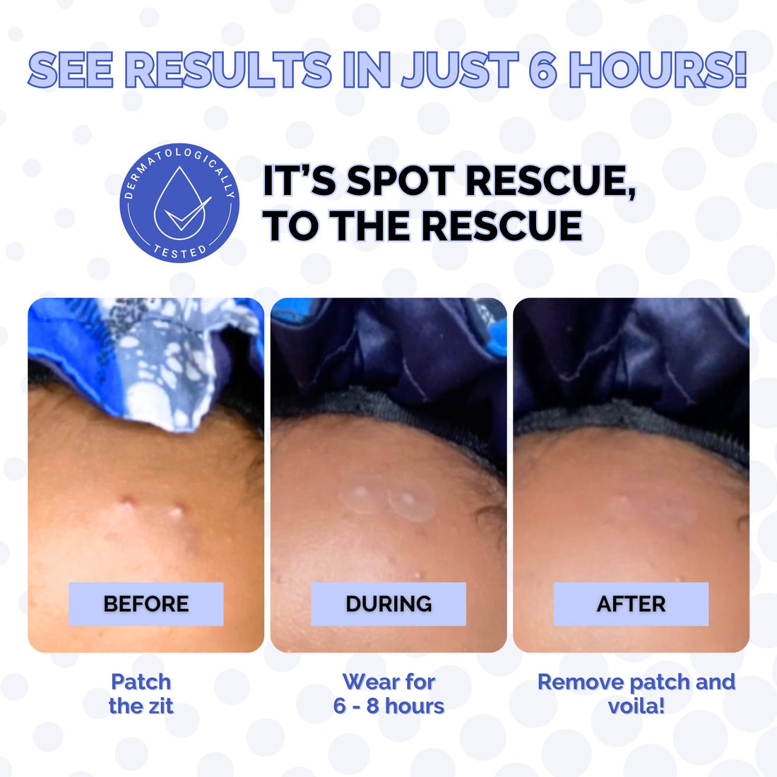 Spot Rescue Blemish Patches
